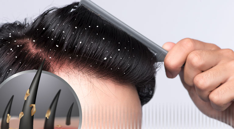 唔理頭皮屑、 搔癢、發紅，可能會過早脫髮?